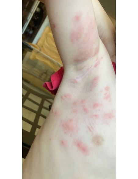 Alergia Acaros Tratamiento 【TIENDA】 Alergia Acaros Tratamiento 【TIENDA】