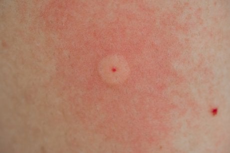 picadura de avispa